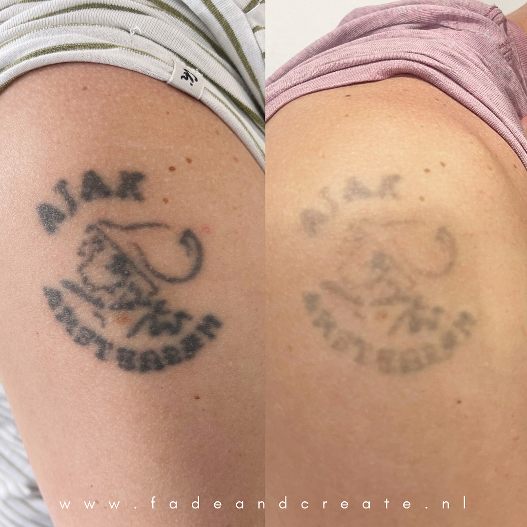 tatoeage verwijderen
